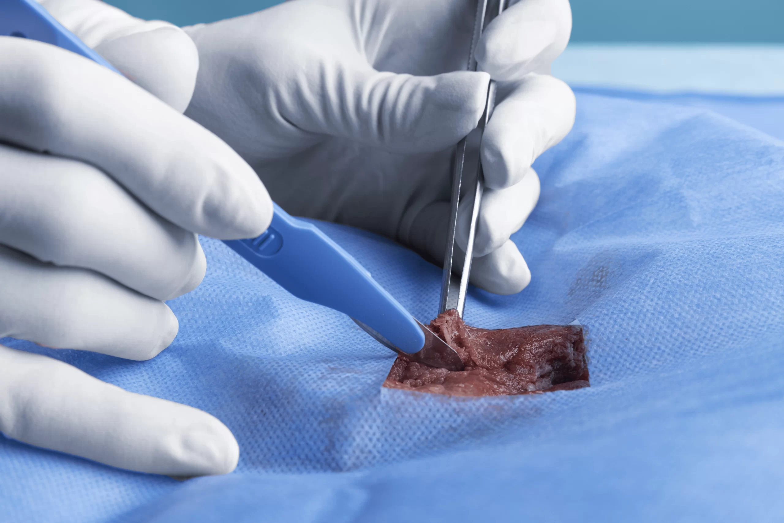 Tumor Removal & Resection