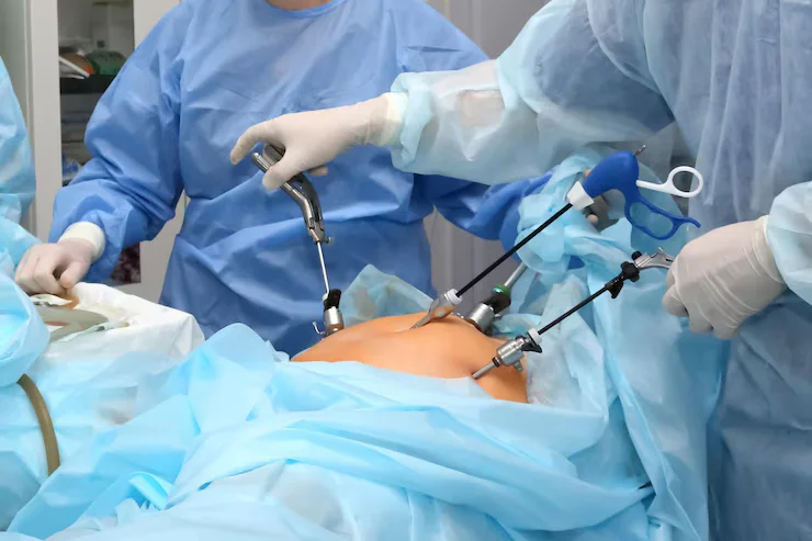 Laparoscopic Appendectomy