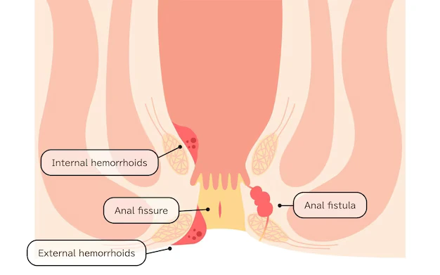Fissure