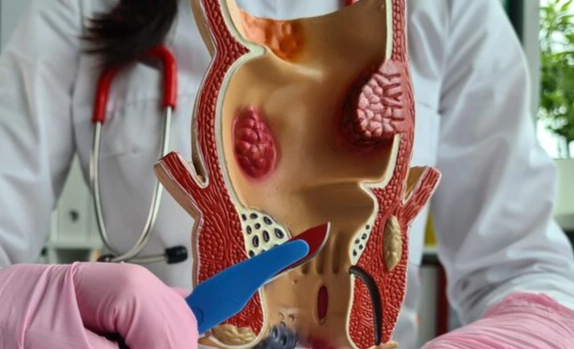 Fistula