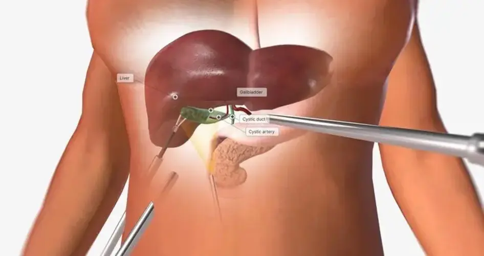 Cholecystectomy (Gall Bladder Surgery)