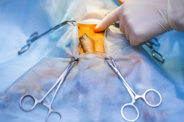 Laparoscopic Hernia Repair 